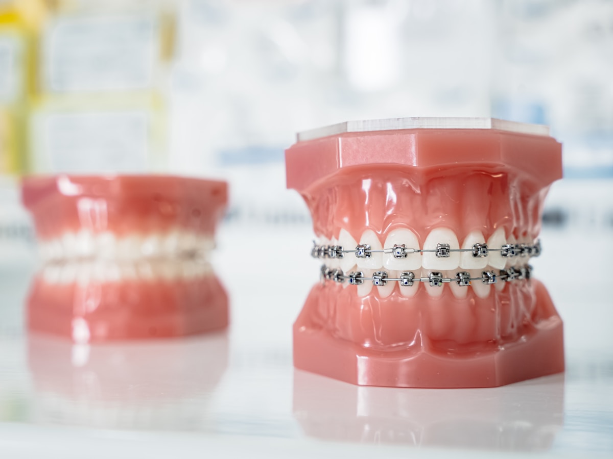 Self-Ligating Braces